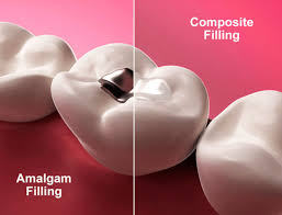 Tooth-Colored Filling & Restorations